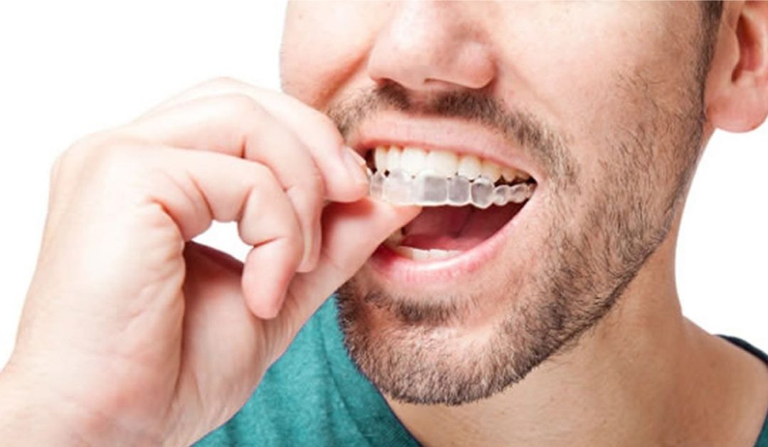 O primeiro passo para o sorriso que você sempre quis | Invisalign